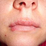 Lippenherpes (Herpes labialis), ein weitverbreitetes Problem